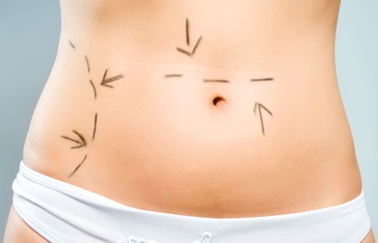 Modellare il proprio corpo con la liposuzione tumescente