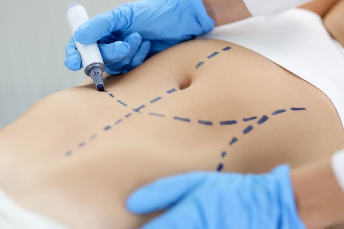 Chirurgia combinata dell’addome: quando è consigliata